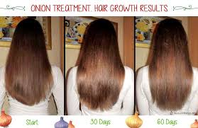 Onion For Hair Growth 